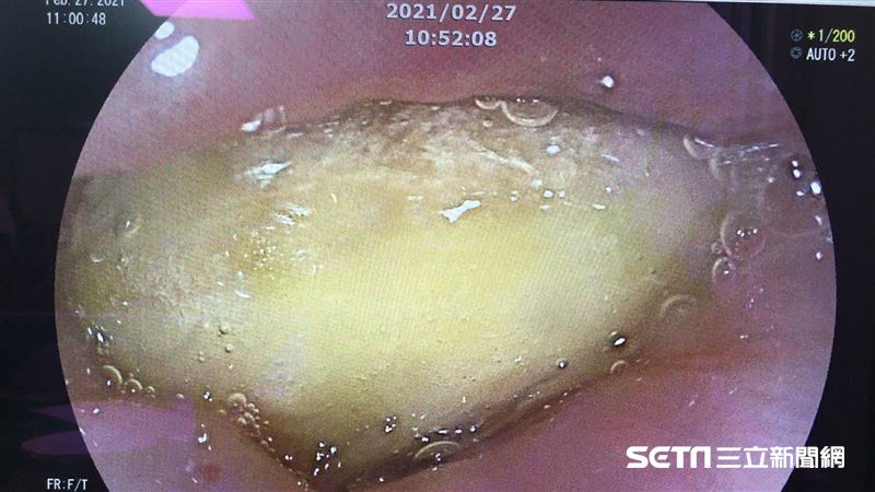 他挺台灣鳳梨卻噎到　緊急內視鏡夾出