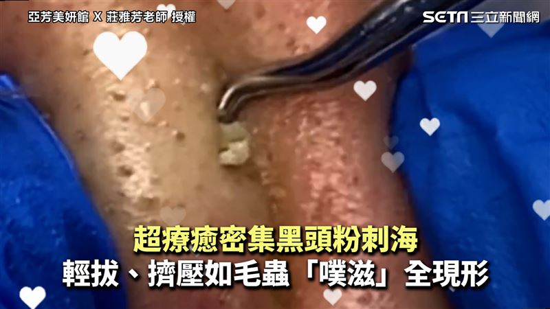 療癒黑頭粉刺海　擠壓如毛蟲般全現形