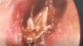 ▲醫師在小女孩耳裡看到死去的蟑螂。（圖／翻攝自微信）