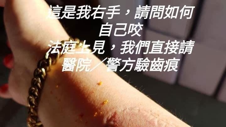 她遭婆婆咬手臂潑蠟油　只因開了冰箱