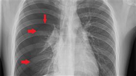 箭頭處為被空氣壓迫而坍塌的肺部（圖／亞東醫院提供）