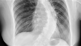 X光脊椎側彎（圖／亞大醫院提供）