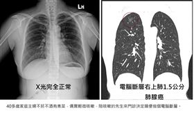 胸腔重症醫師蘇一峰在部落格以及臉書分享真實案例提醒，千萬不要以為胸部X光正常就等於沒有肺癌！（圖／蘇一峰醫師提供）