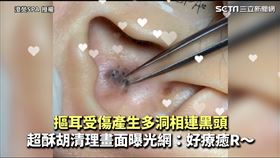摳耳受傷產生多洞相連黑頭　超酥胡清理畫面曝光網：好療癒R～