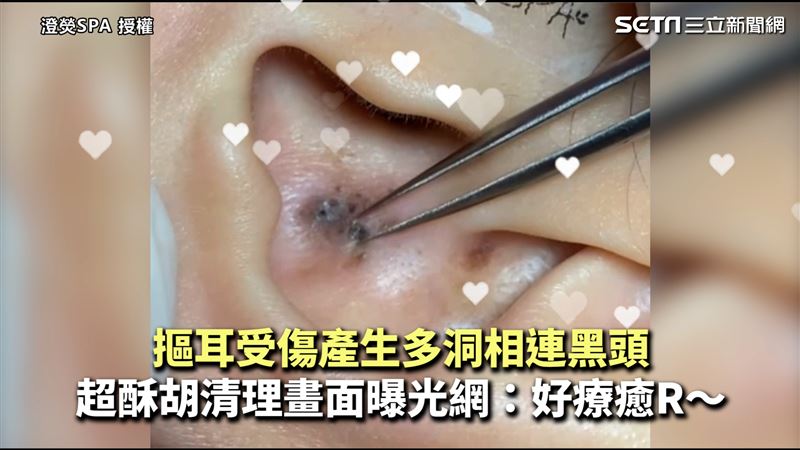 多洞相連黑頭　超酥胡清理畫面曝光