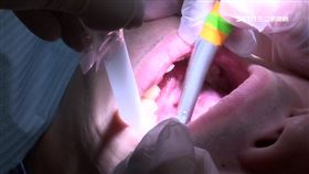 蛀牙細菌竄眼! 眼內炎.蜂窩性組織炎險失明