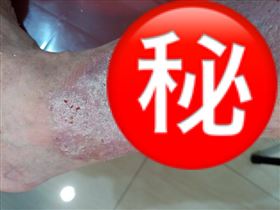 乾癬患者腳部病灶。（圖／台灣乾癬協會提供）
