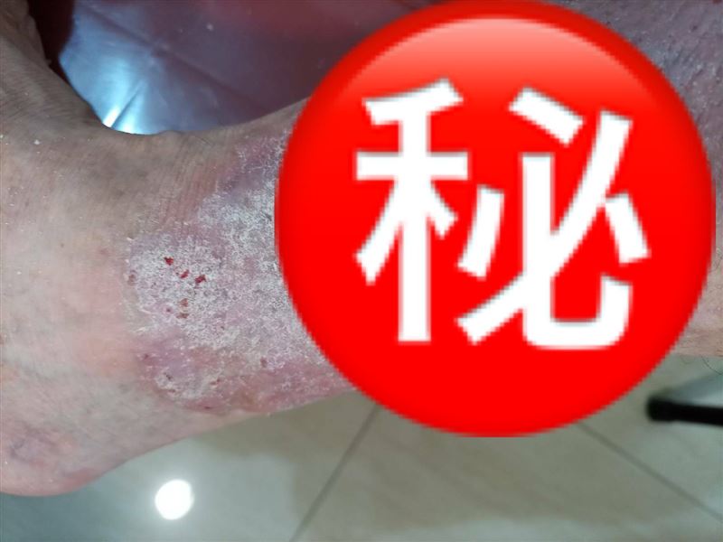 獨／重度乾癬藥「被下車」護理師絕望