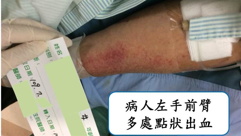婦手腳突瘀青　醫一看驚覺腦出問題