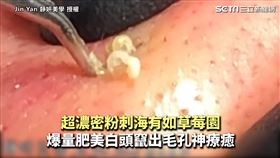 超濃密粉刺海有如草莓園　爆量肥美白頭竄出毛孔神療癒