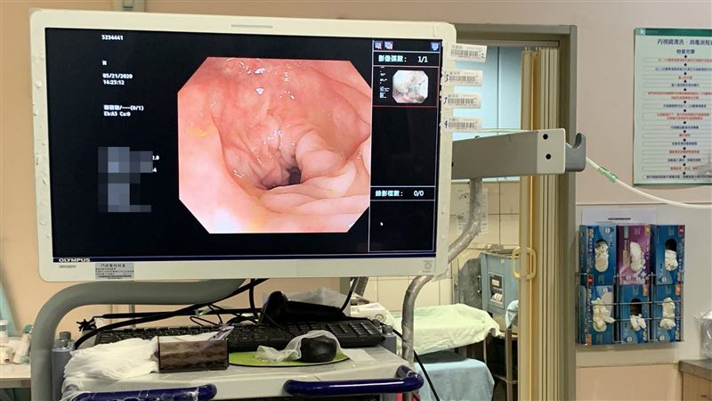 血便以為痔瘡　拖了1個月發現大腸癌