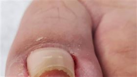一位50歲男性因修剪腳指甲方式不當，產生卷甲合併甲溝炎症狀。（圖／書田醫院提供）