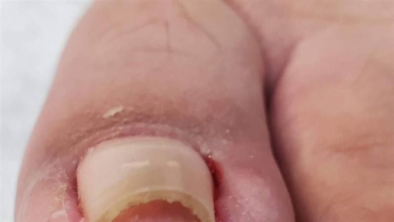 愛剪短腳指甲　熟男竟得甲溝炎