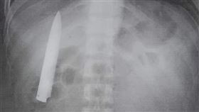 菲律賓男子，遭持刀刺傷，胸口藏1把刀10公分，長達1年多，照X光片才發現