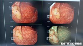 大腸鏡(讀者提供)