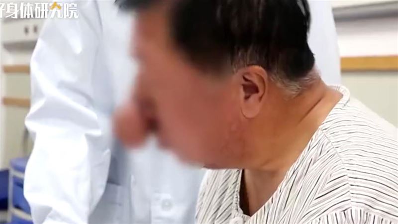 40年喝萬斤白酒　他鼻子大如百香果
