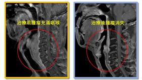 黃先生接受引導式化療治療前後比較，腫瘤明顯消失（圖／台中慈院提供）