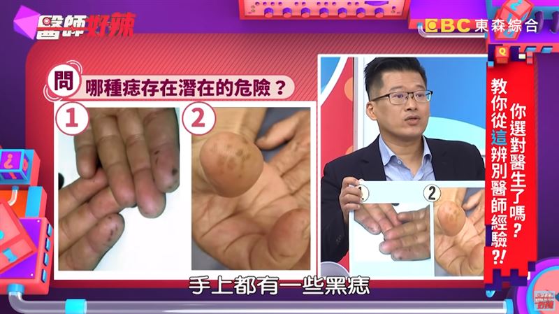 手嘴冒詭異黑斑　眼尖醫：快做大腸鏡