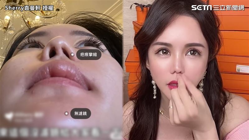隆鼻6次全失敗　她曝變形模樣嘆後悔