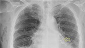 64歲男心房顫動險中風　「迷宮手術」救命（圖／台北慈院提供）