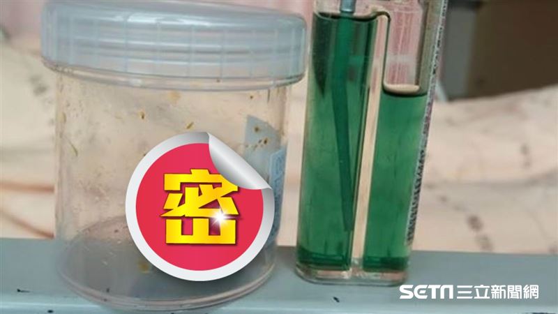 獨／3公分巨型膽結石現形　宛如鐵蛋
