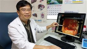 嚇！七旬翁一天一包菸　三到五天沒排便、竟是大腸癌（圖／大千綜合醫院提供）