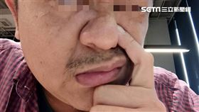 耳鼻喉科,鼻息肉,息肉,鼻塞，流鼻水,感冒，示意圖/資料照