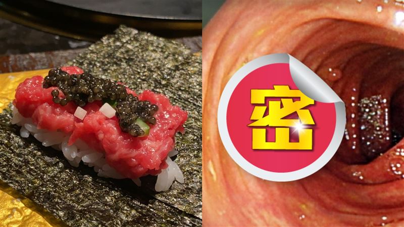 男愛吃生食狂腹瀉！醫照大腸末端驚呆