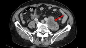 翁誤信喝草藥「顧腰子」　結果輸尿管癌上身、長8公分腫瘤（圖／亞大醫院提供）
