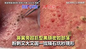 鼻翼旁超巨型黑頭密如部落　粉刺又大又圓一拔隕石坑秒現形