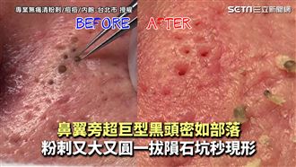 黑頭密如部落　粉刺一拔隕石坑秒現形