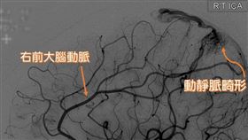頭痛、左半身無力　竟是腦動靜脈畸形(慈濟醫院提供)