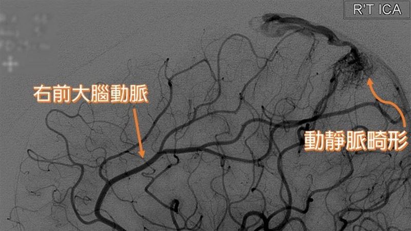 頭痛、左半身無力　竟是腦動靜脈畸形