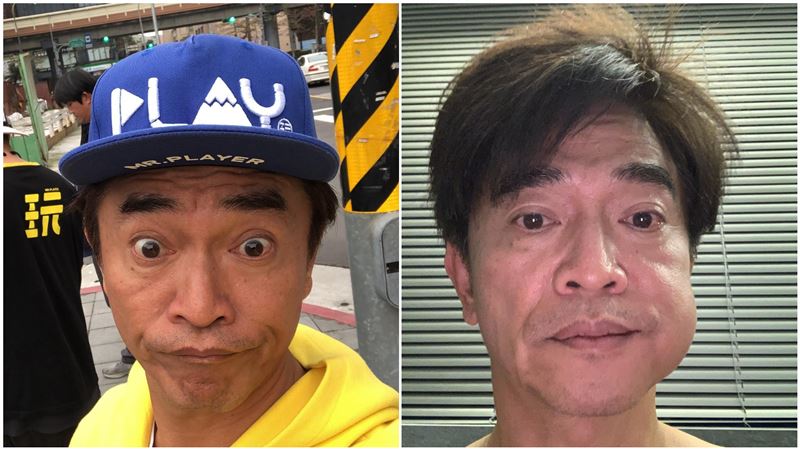 憲哥「臉腫一包」網嚇壞！本人揭原因