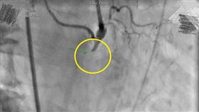 每天抽1.5包菸長達30年　鳳梨農「心肌梗塞」急救險死(南投醫院提供)