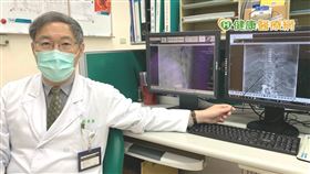 劉康渡主任解釋，脊髓刺激療法是一種神經調控的療法，將一個電極線，植入脊髓硬膜的外腔，刺激中樞脊髓背部的神經纖維，調節傳導至腦部的不正常訊號，達到控制疼痛的目的。