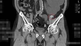 左側輸尿管被多顆結石完全填塞（圖／翻攝自彰化醫院官網）