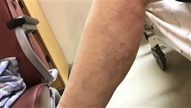 靜脈曲張／心臟血管外科醫師張雲媛（恩主公醫院提供）