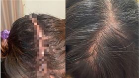 左邊為不剃髮下完成的手術照、右邊為復原照（圖／長安醫院提供）
