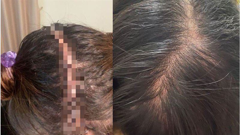 擠痘痘流膿不止　竟發現腦硬膜下積水