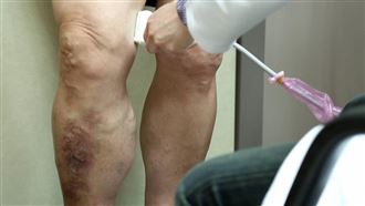 「浮腳筋」20年沒在管！婦雙腿劇痛走不了