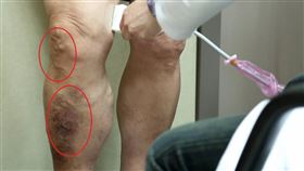 靜脈曲張(長庚醫院提供)