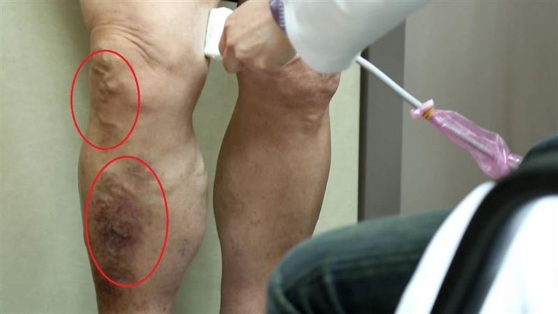 腳部「浮青筋」別輕忽　研究：恐致命