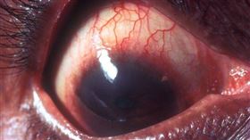 2歲以下別玩手機　醫曝「恐怖原因」,壢新醫院, 聯新國際醫院, 急性青光眼發作, 張文瑞