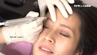 紋眉長50顆小肉芽　女遭病毒疣入侵