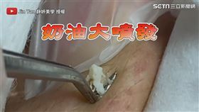 ▲美容師一擠壓乳白粉刺大噴發。（圖／Jin Yan 靜妍美學 授權）