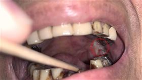 致癌三寶不離身　50歲舌癌男治癒又罹頰黏膜癌（圖／亞大醫院提供）