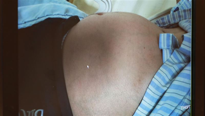男肚腫像懷孕　竟遭4公斤巨癌塞滿