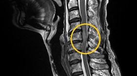 頸椎損傷(南投醫院提供)