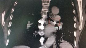 廣東老翁魚骨卡氣管逾60年 圖／翻攝自東莞日報微博